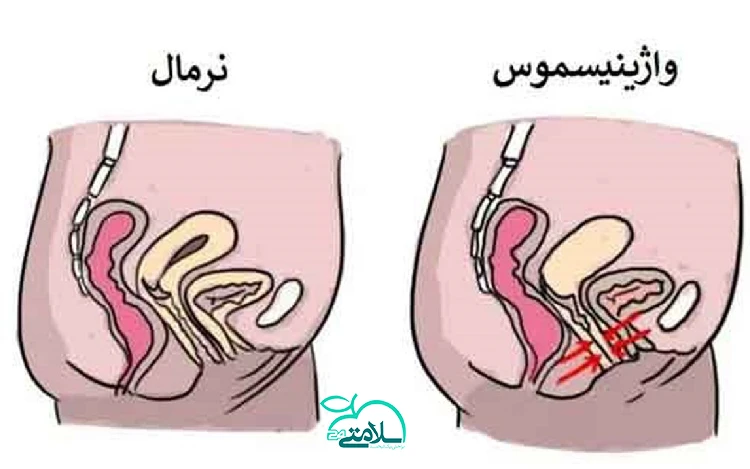 تمام آنچه که درباره بوتاکس واژن باید بدانید